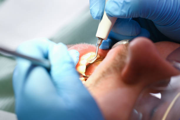 Best Emergency Wisdom Tooth Extraction in West Bishop, CA